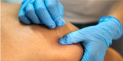 Dry Needling